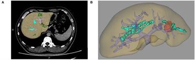 Feasibility Study of Intelligent Three-Dimensional Accurate Liver Reconstruction Technology Based on MRI Data